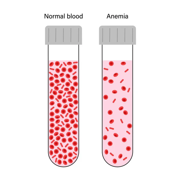 Normal & Anemia Blood - Graphics